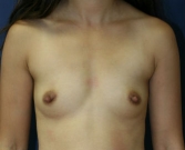 Feel Beautiful - Breast Augment San Diego, Case 60 - Before Photo